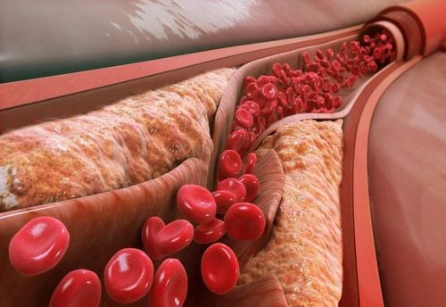 Giảm mỡ máu hiệu quả nhờ Omega 3 Krill