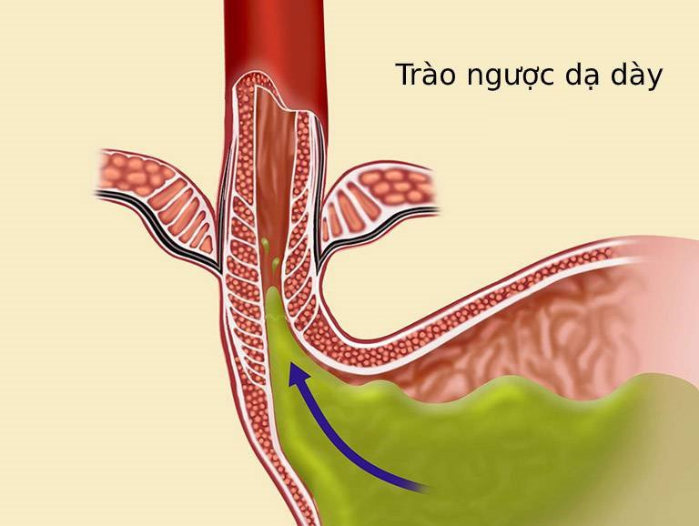 Trào ngược dạ dày thực quản: Nguyên nhân và dấu hiệu nhận biết
