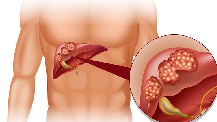 5 nguyên nhân gây ra bệnh gan nhiễm mỡ