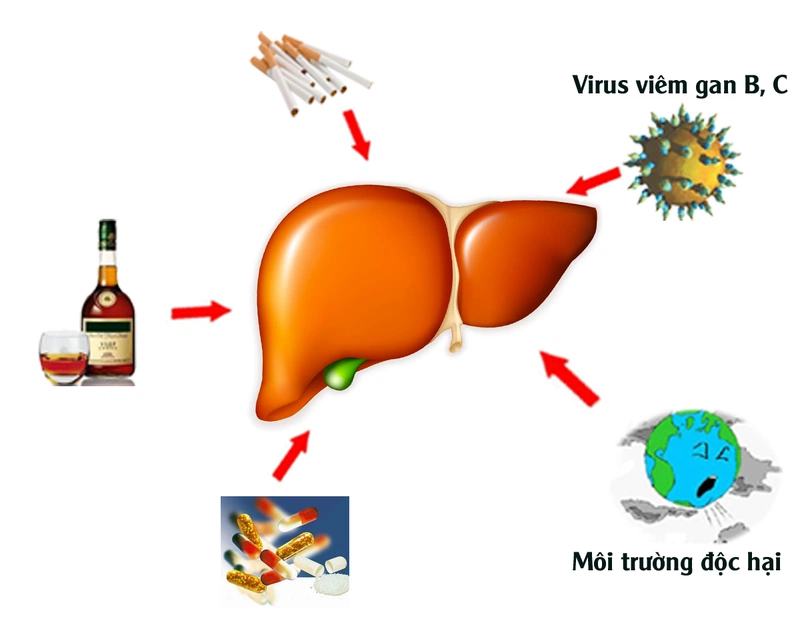 Xơ gan là gì? 5 nguyên nhân dẫn đến bệnh xơ gan