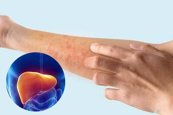 Xơ gan là gì? 5 nguyên nhân dẫn đến bệnh xơ gan