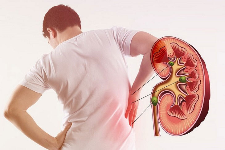 Suy thận cấp là gì? 4 điều cần biết về suy thận cấp để điều trị hiệu quả