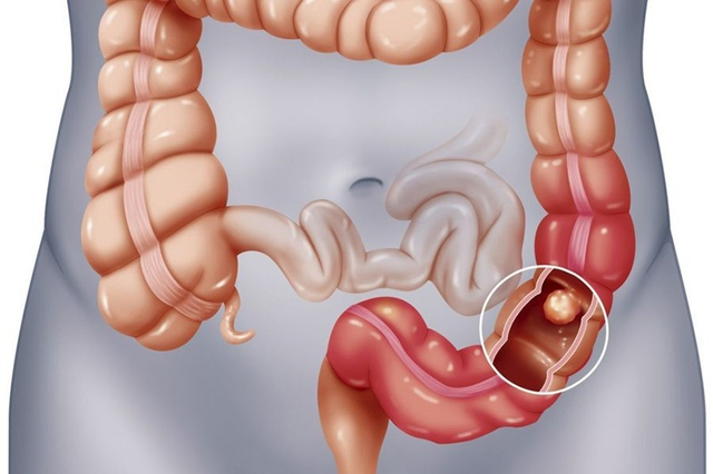 Viêm đại tràng: 7 điều cần biết và cách phòng tránh hiệu quả