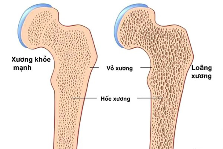 Bệnh loãng xương: Nguyên nhân, triệu chứng và cách phòng ngừa